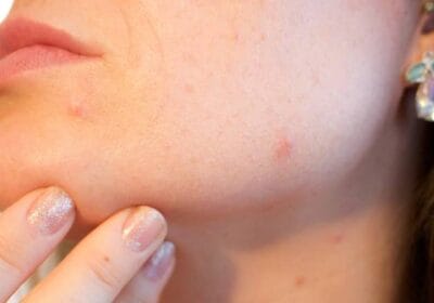 Can Getting An IUD Make Your Acne Worse