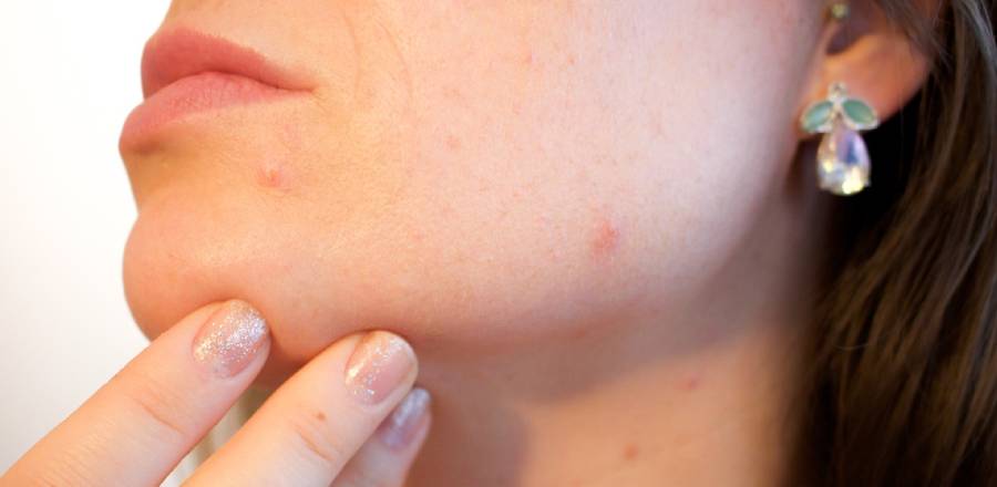 Can Getting An IUD Make Your Acne Worse Can Getting An IUD Make Your Acne Worse