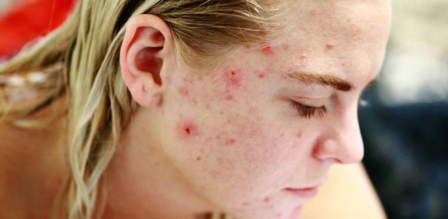 Facing Acne Facing Acne